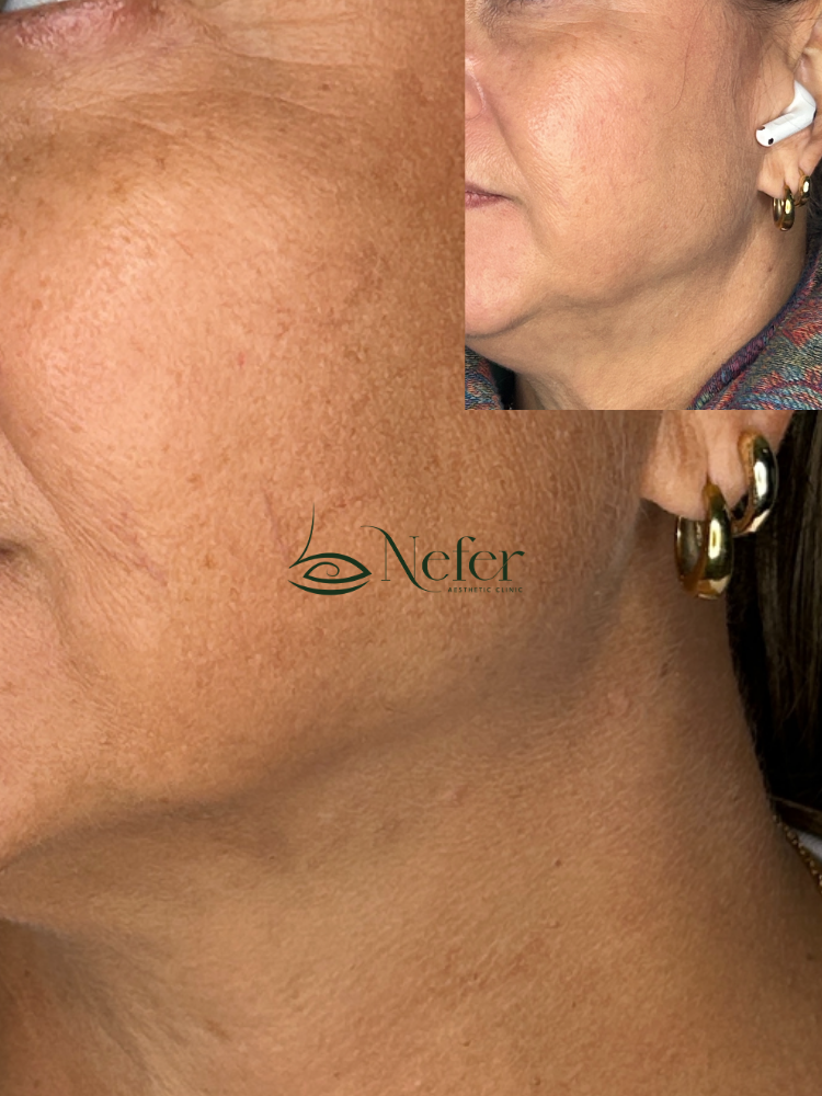Rejuvenecimiento facial